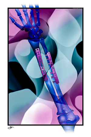 PURPLE Plated-Radius-Ulna